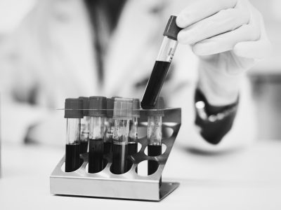 Des recherches en cours à l’IPC pour utiliser la « biopsie liquide » dans le monitoring de l’ADN des cancers du sein